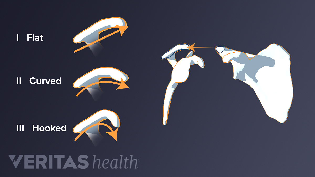 shoulder-impingement-acromion-shapes-illustration.png