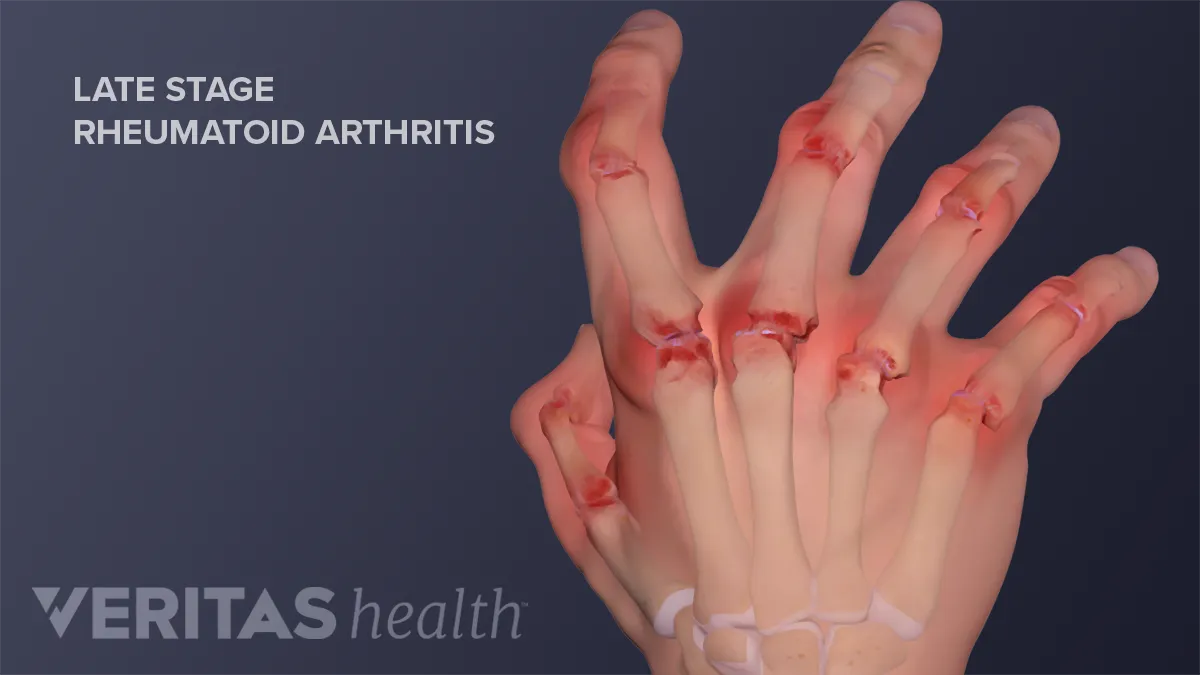 Treatments for Rheumatoid Arthritis in Hands | Arthritis-health