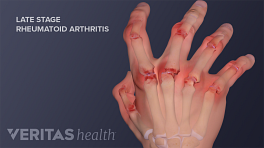 Hand showing severe joint destruction and deformity caused by late stage rheumatoid arthritis.