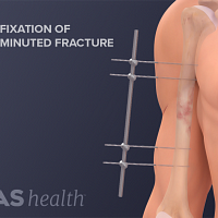 Illustration of an external fixation of an open comminuted humerus fracture