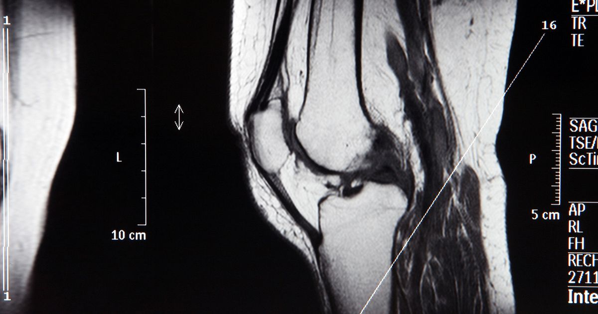 Diagnosing MCL Sprains And Tears