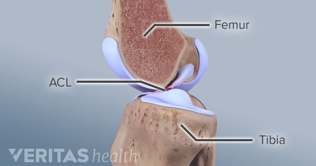 4 Risk Factors for ACL Injuries That You Need to Know