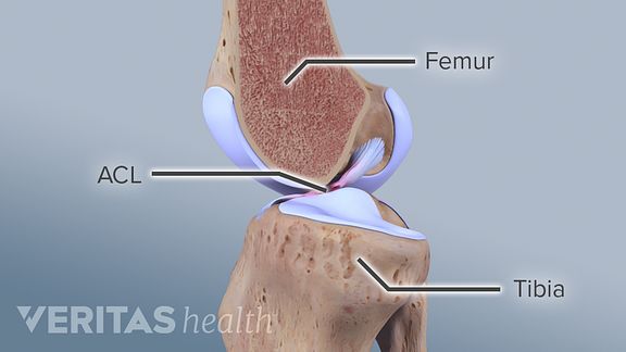 4 Risk Factors for ACL Injuries That You Need to Know