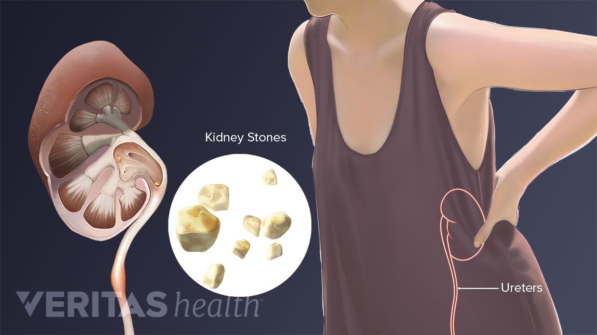Kidney Stones ?keep=c&crop=yes&u=o5culx&use=mf1k7