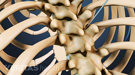 A biopsy entering between vertebra for a vertebroplasty procedure