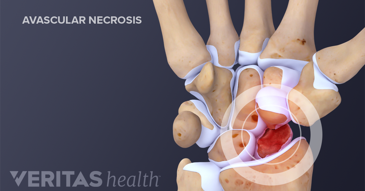 Diagnosing And Treating Scaphoid Fractures Of The Wrist 