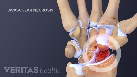 scaphoid pain but no fracture