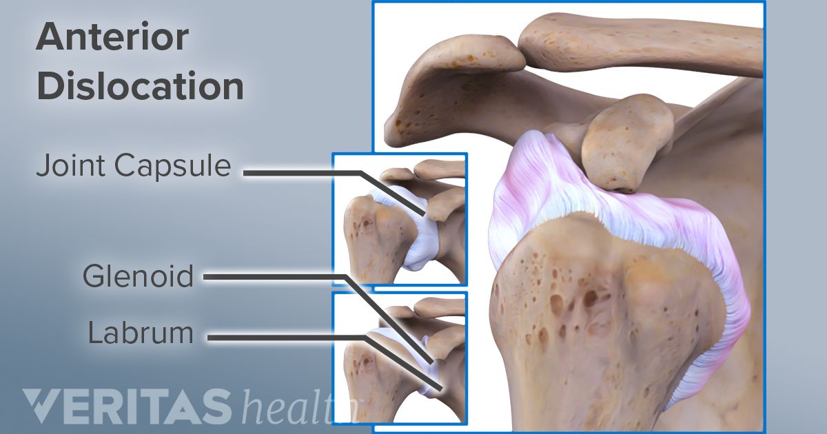 3 Causes of Shoulder Instability