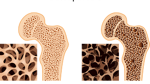 骨质疏松