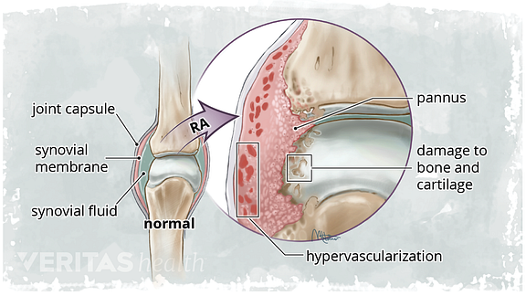 Pannus sano vs diagrama de pannus reumatoide