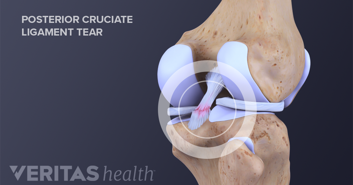 Symptoms Of Posterior Cruciate Ligament (pcl) Tears