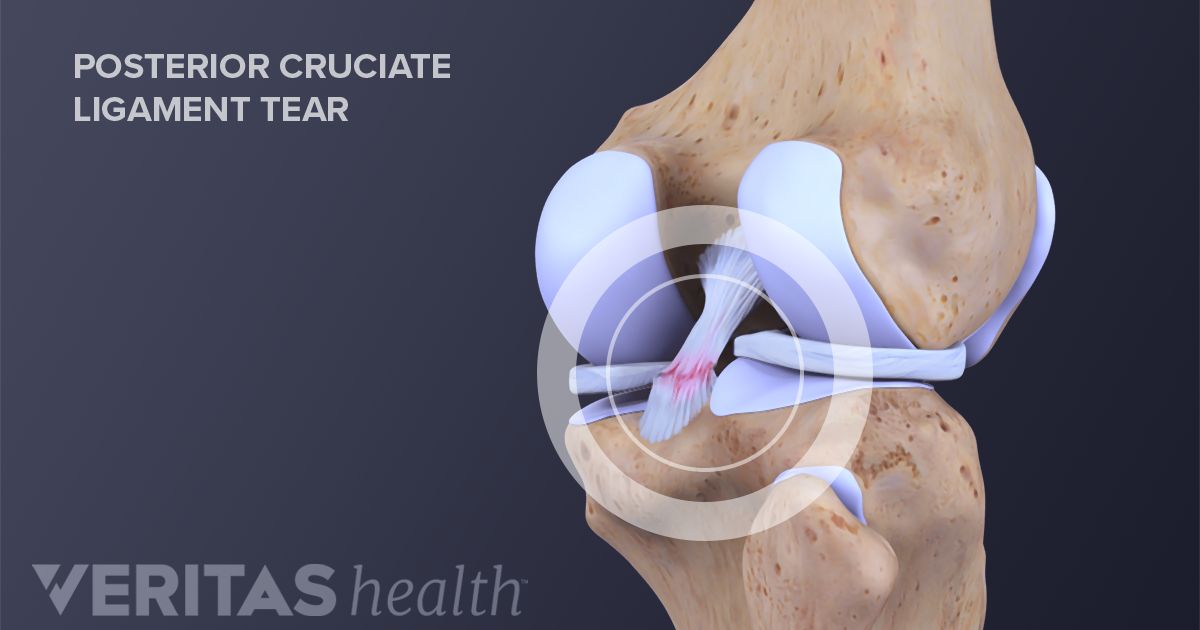 Posterior Cruciate Ligament Exercises