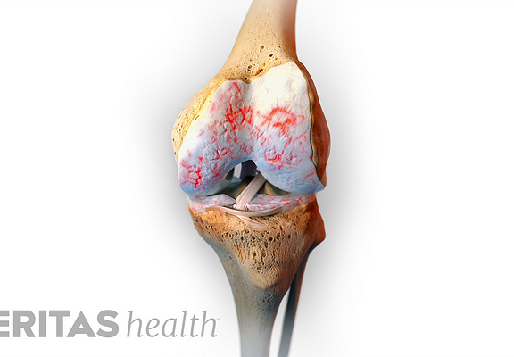 Knee Osteoarthritis