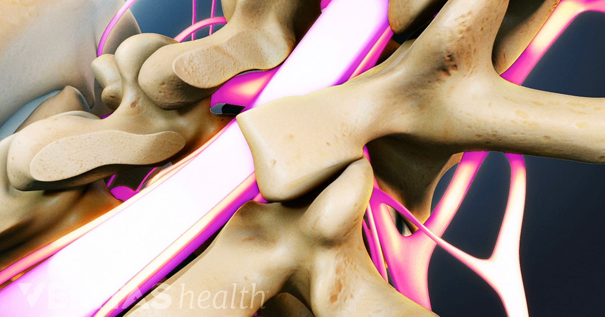 Internal Bone Growth Stimulators For Spine Fusion