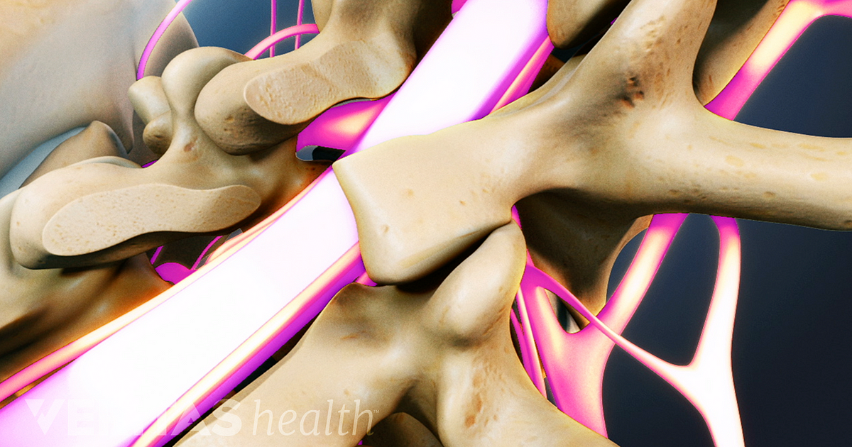 Internal Bone Growth Stimulators for Spine Fusion