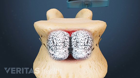 A Visual Guide to Understanding Kyphoplasty