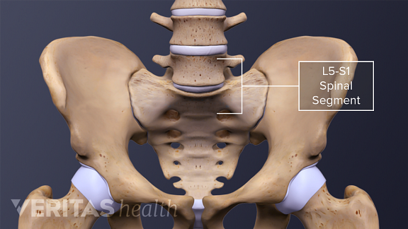 Anterior view of the pelvis labeling the L5-S1 Spinal Segment.