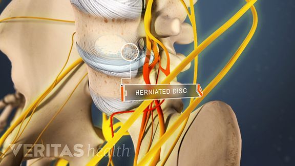 How Lumbar Steroid Injections Deliver Back Pain Relief