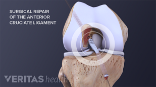 Which ACL Graft Is Right for You?