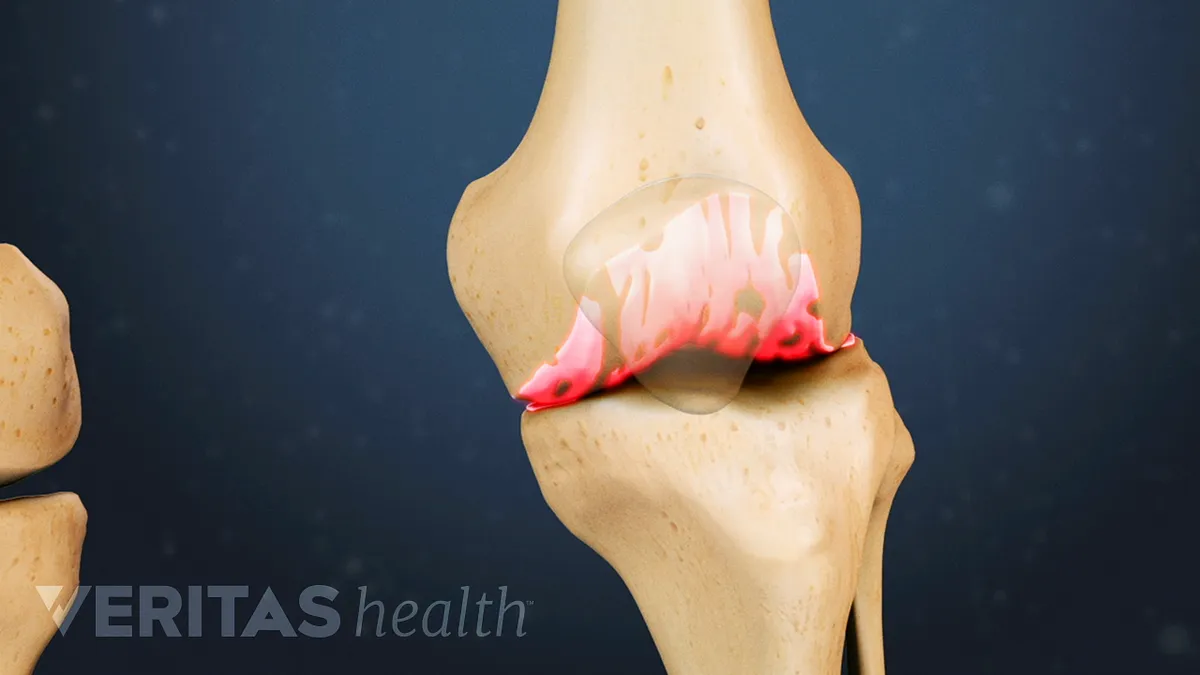 ballet slå synge Crepitus May Be Early Warning Sign of Knee Arthritis | Arthritis-health