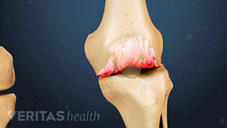 Medical illustration of the knee joint showing osteophytes highlighted in red to indicate pain