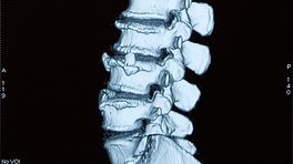 Profile view of an xray of the lumbar spine.