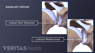 Surgery For Dislocated Shoulder