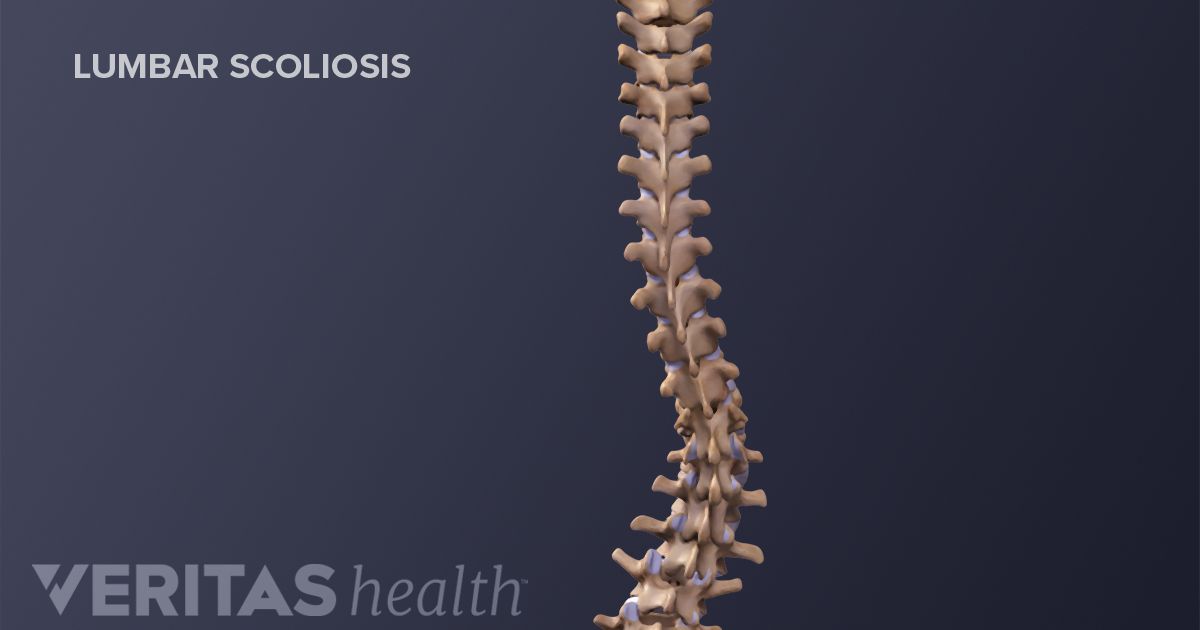 Degenerative Scoliosis Symptoms And Diagnosis