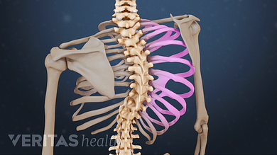 juvenile rheumatoid arthritis and scoliosis