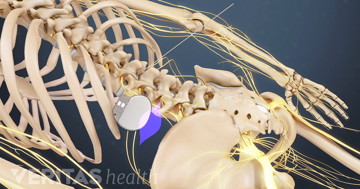 Spinal Cord Stimulation For Chronic Back Pain Video