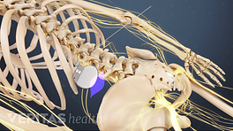 Posterior view of the spinal cord stimulator in the lumbar spine.