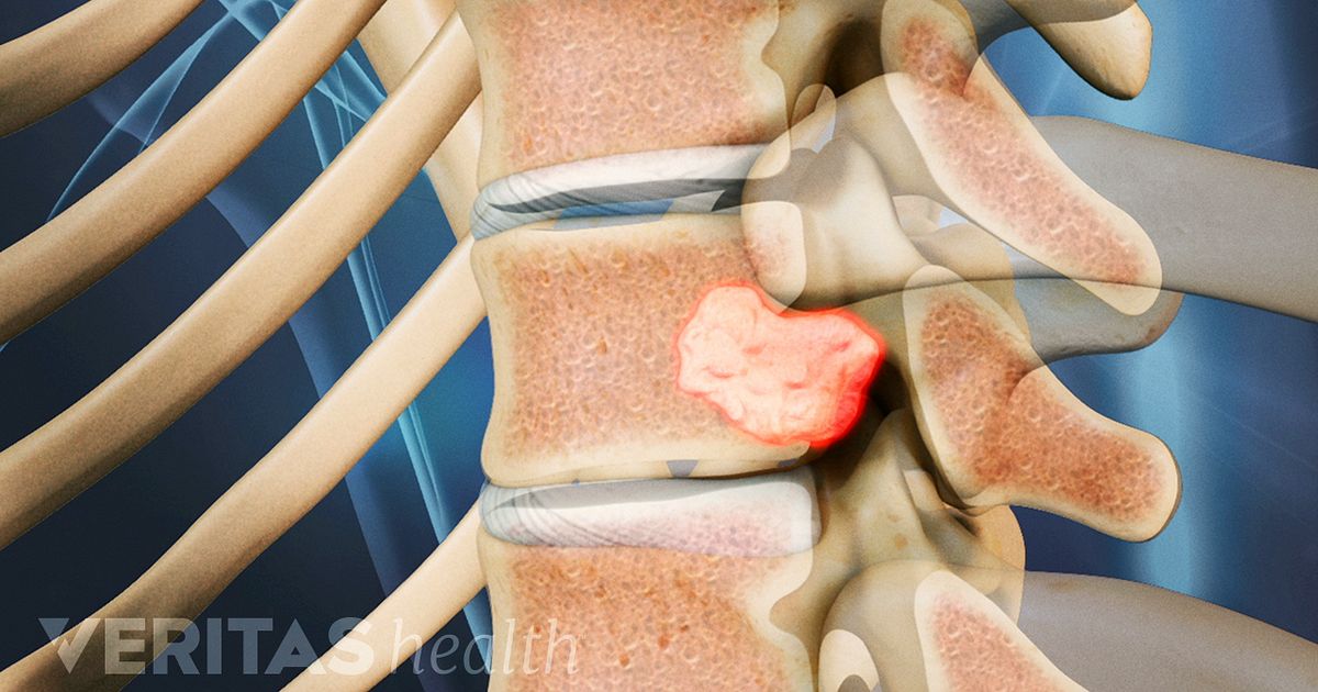Vertebre cancer