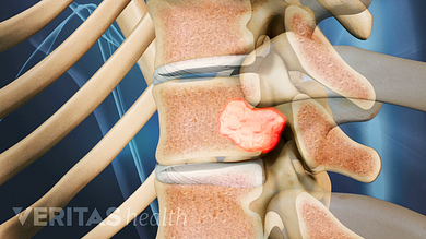 cancer metastatic to spine