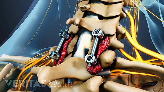 Cervical Laminectomy