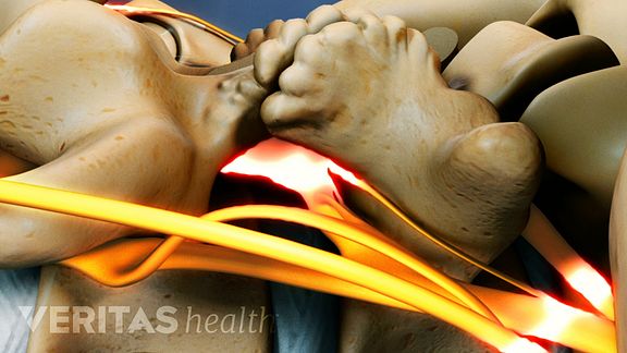 lumbar laminectomy