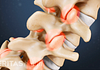 Vertebrae of the spine showing pain at the facet joints