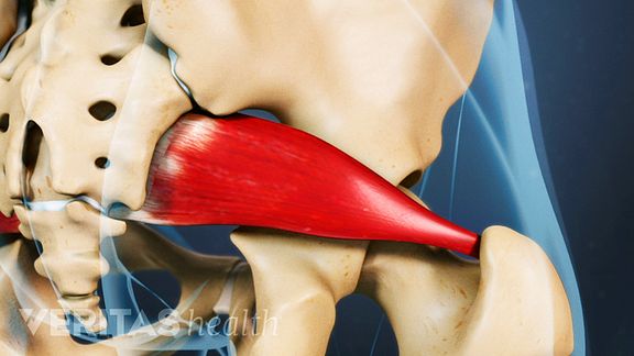 Piriformis Syndrome with Sciatic Nerve Compression