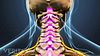 Cervical Stenosis with Myelopathy