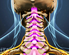 Posterior view of the cervical spine showing spinal stenosis.