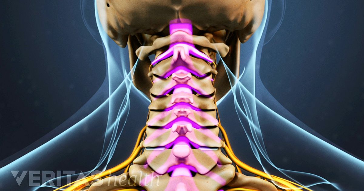 How Cervical Stenosis with Myelopathy Affects Your Body