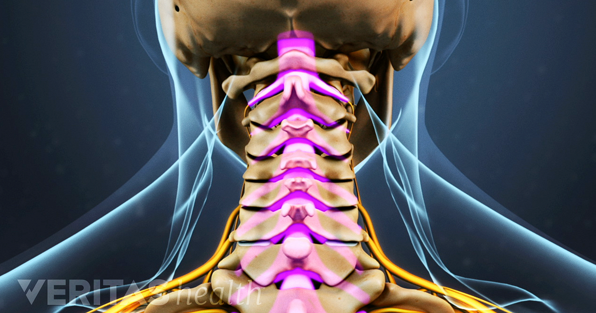 Cervical Foraminal Stenosis