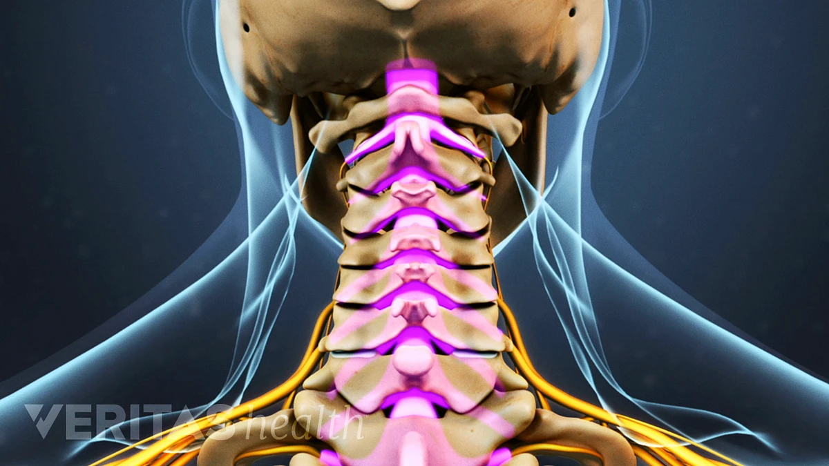 Top Four Causes of a Stiff Neck