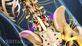 Posterior view of the lumbar spine showing instrumentation from fusion.