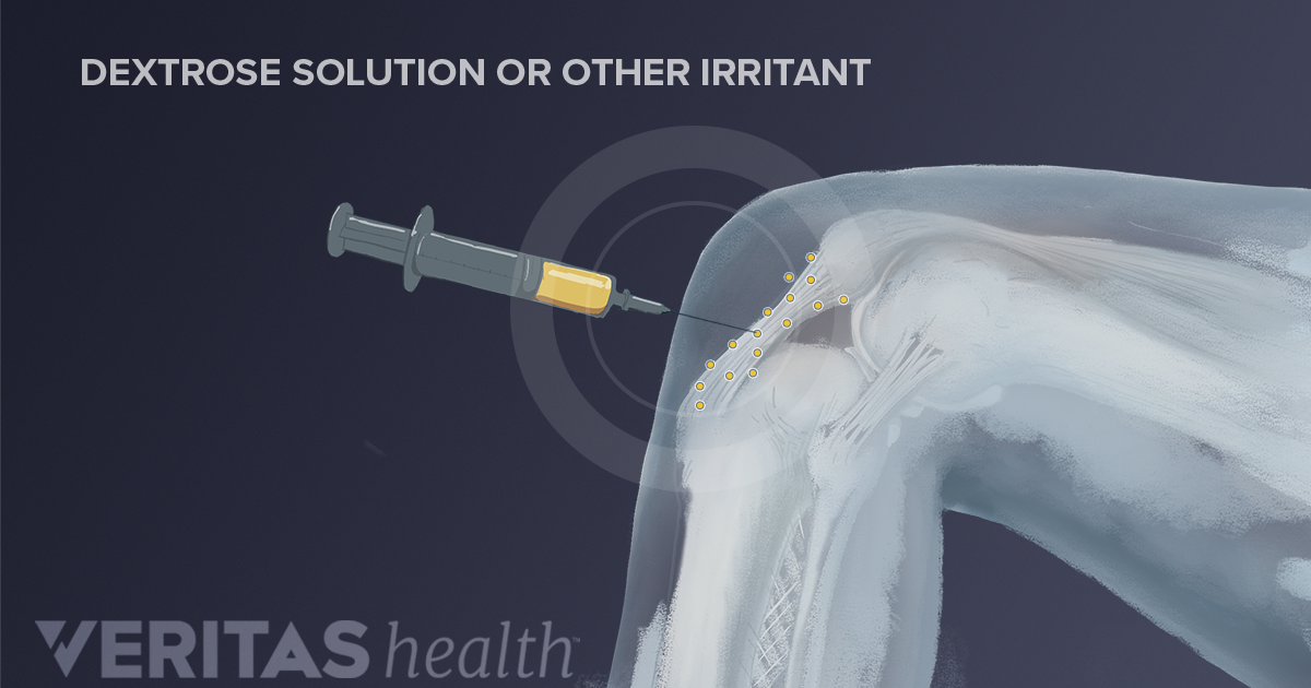 Therapeutic Injections For Sports Related Knee Pain   Knee Prolotherapy Illustration 