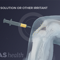 knee prolotherapy injection of dextrose solution or other irritant