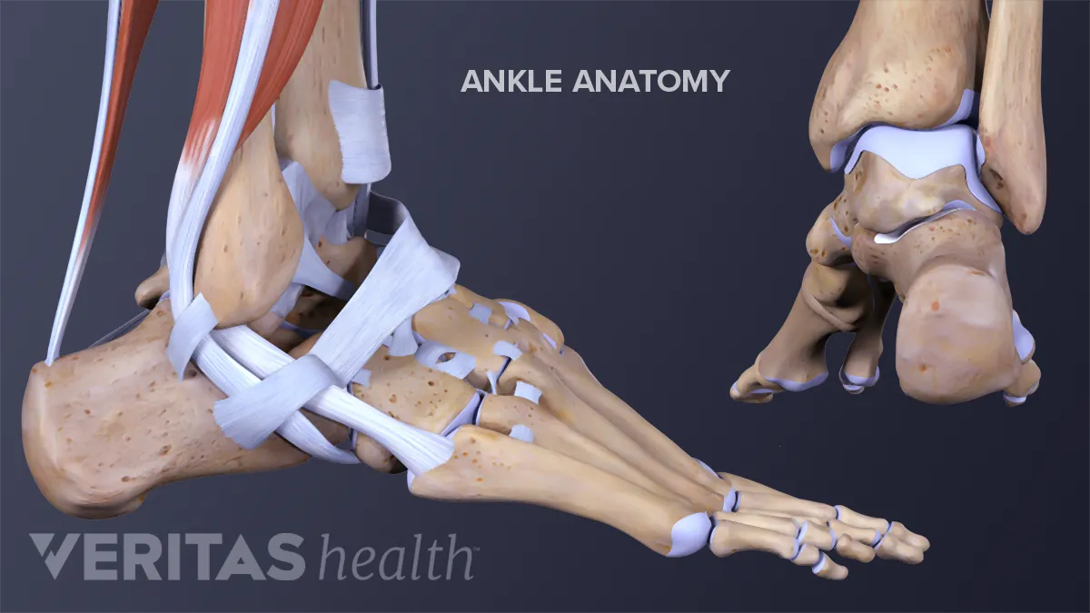 How to Keep an Ankle Sprain From Becoming Chronic Instability