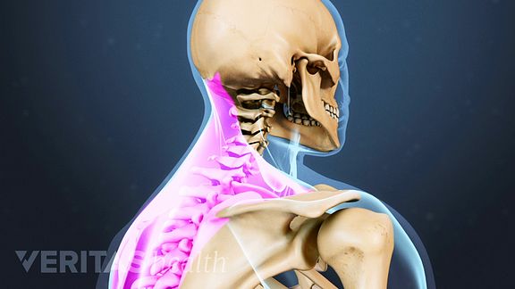 radiating pain in the trapezius shoulder muscles