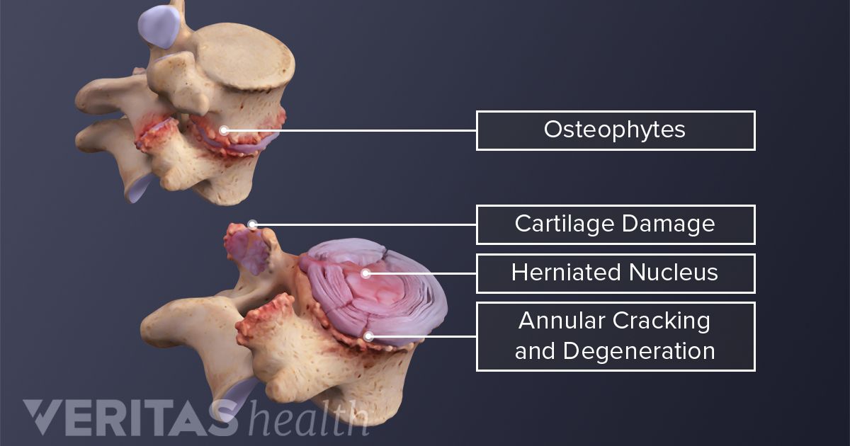 Endoscopic Transforaminal Decompression Interbody Fusion (ETDIF)