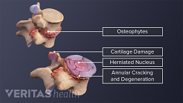 Medical illustration of damaged vertebral segment. Osteophytes, cartilage damage, herniated nucleus, and annular cracking and degeneration are labeled