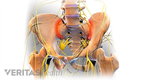 Anterior view of pain in the SI Joint
